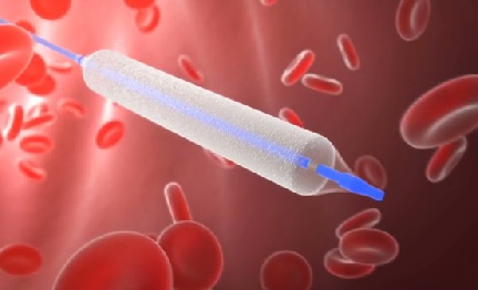 The Below the Knee Drug Eluting Balloon from Platform-14